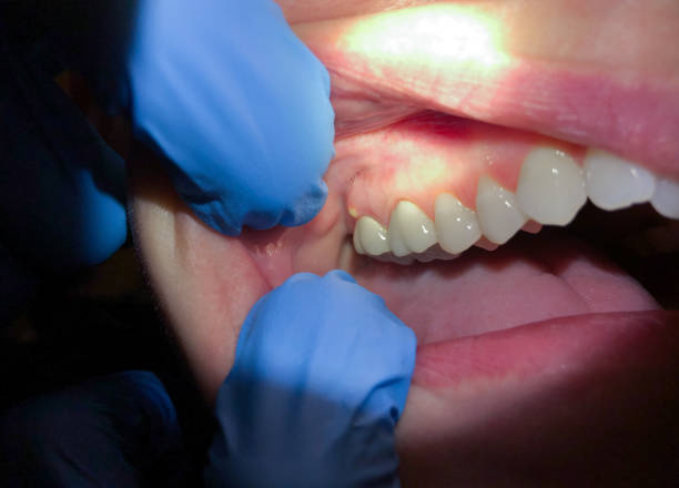 Best Emergency Tooth Extraction in Spout Springs, NC