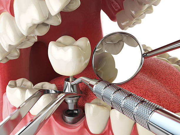 Best Emergency Tooth Extraction in Spout Springs, NC